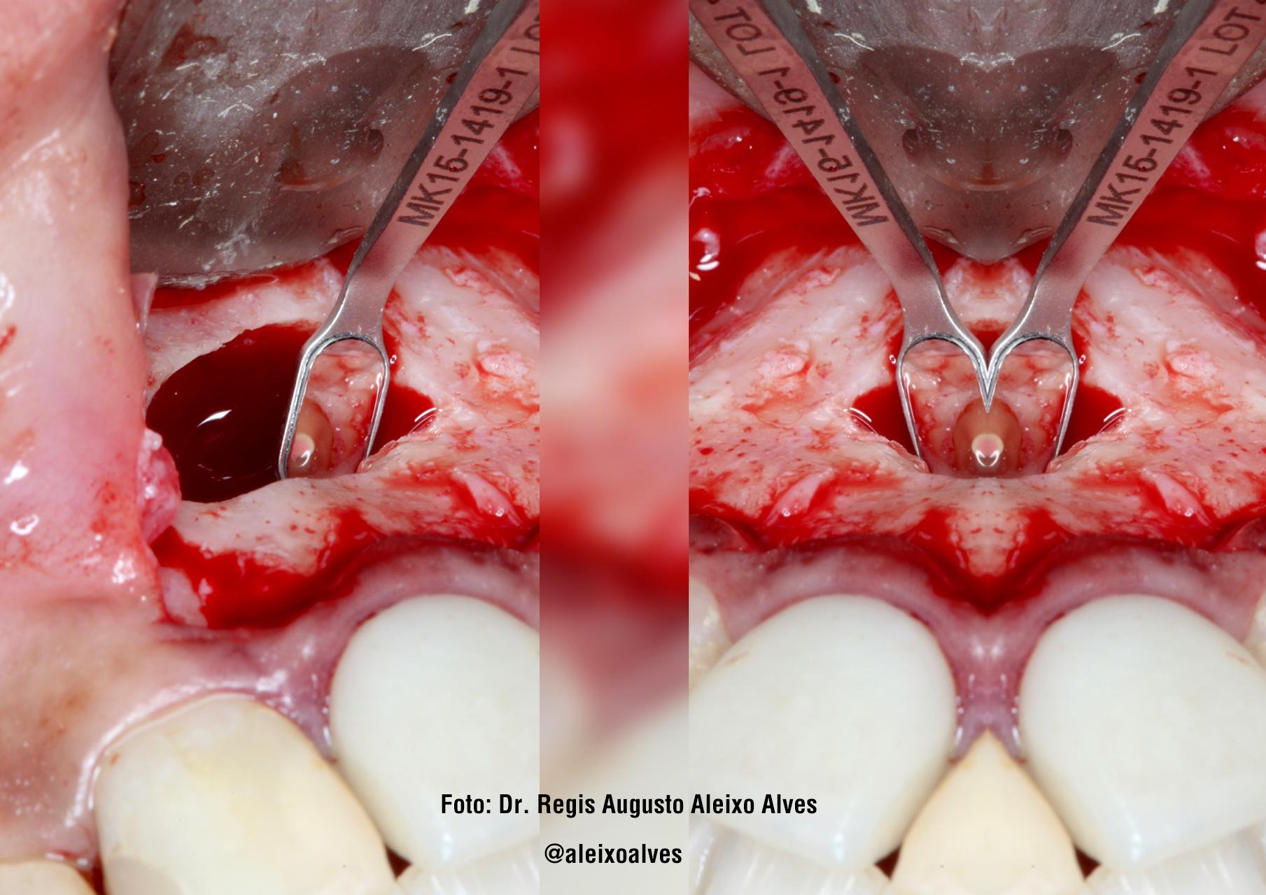 Cirurgia Parendodôntica realizada nos dentes 21 e 22 Dr. Regis Augusto A. Alves
